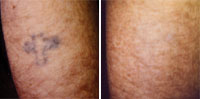 tattoo removal photo
